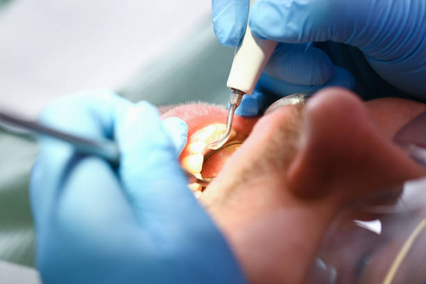 Best Emergency Broken Tooth Repair in Decatur, IL